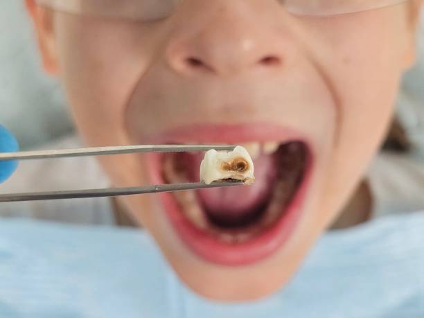 Best Dentist for Tooth Abscess  in Jonesville, VA